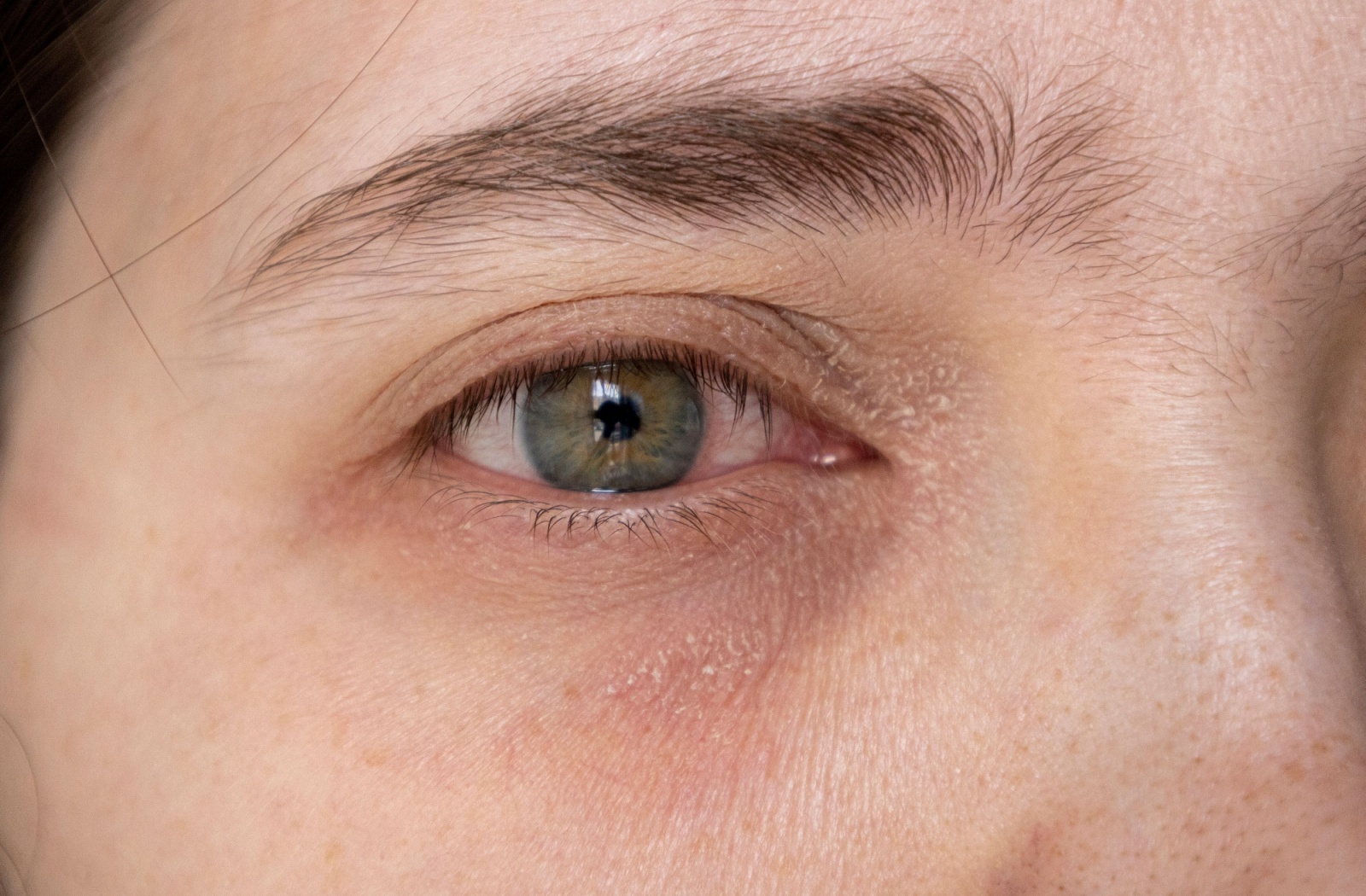 A close up of a person red dry eye