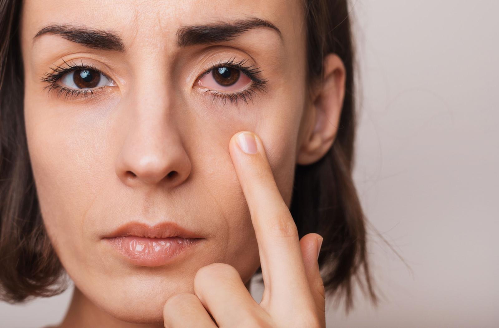 a person with a red eye caused by dry eye